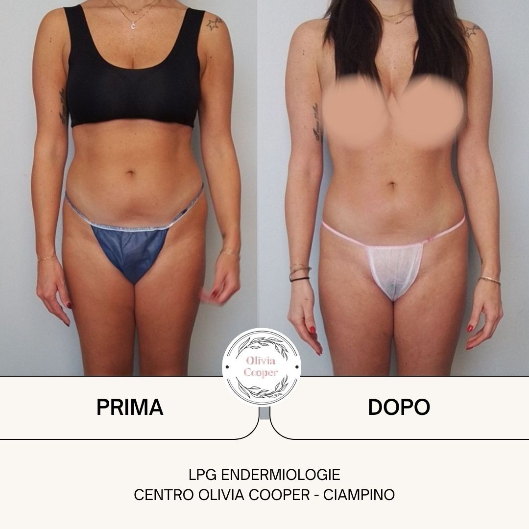 04-Prima-dopo-LPG