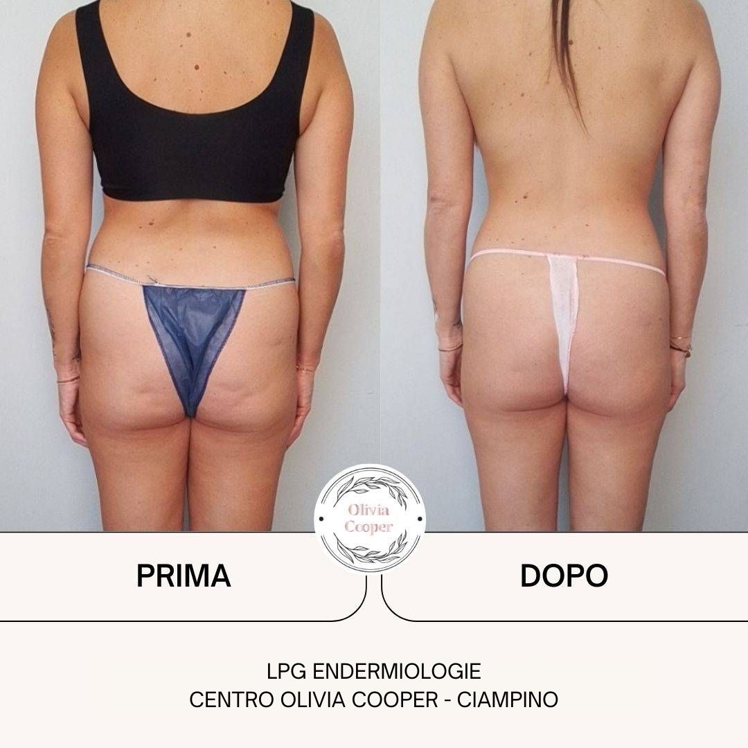 05-Prima-dopo-LPG