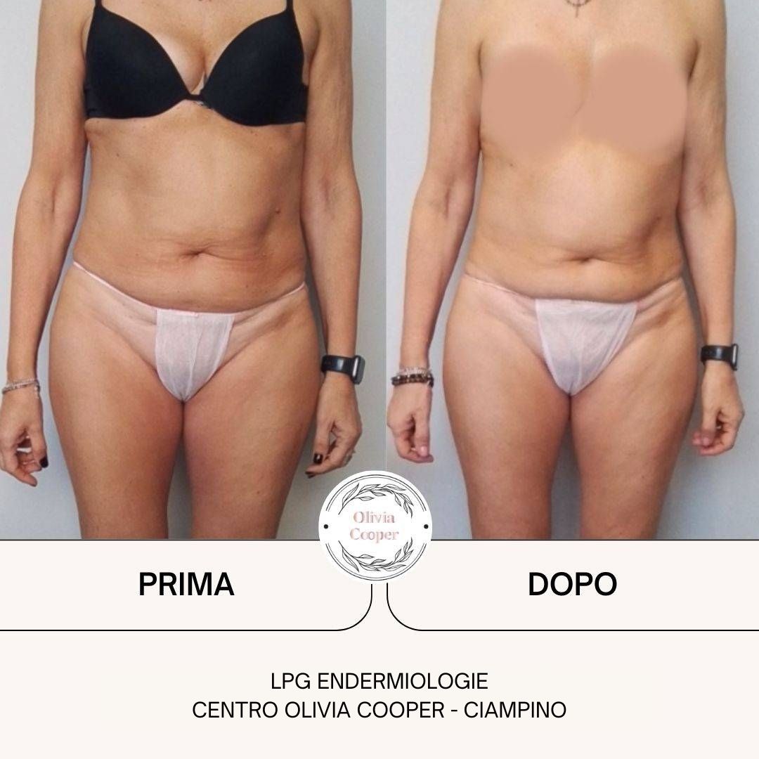 07-Prima-dopo-LPG