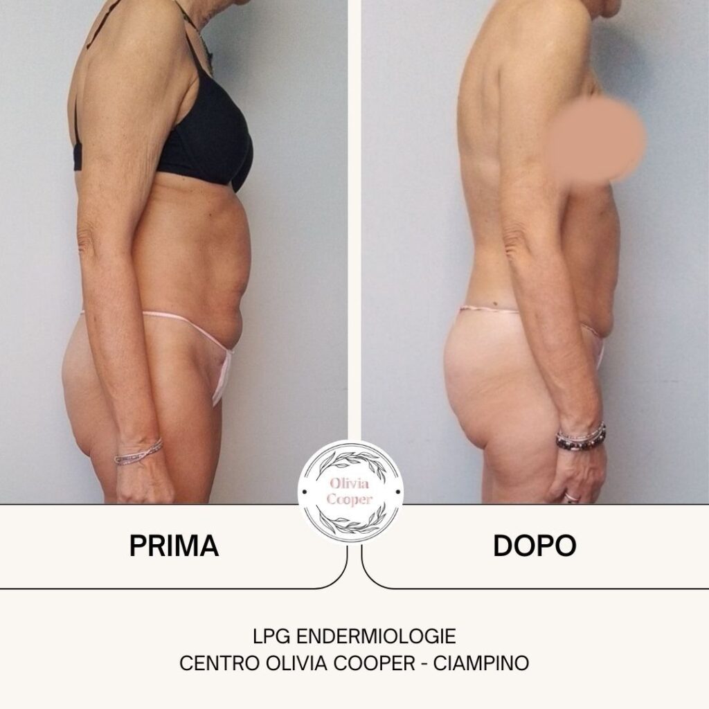 Risultati LPG sull'addome di una nostra cliente