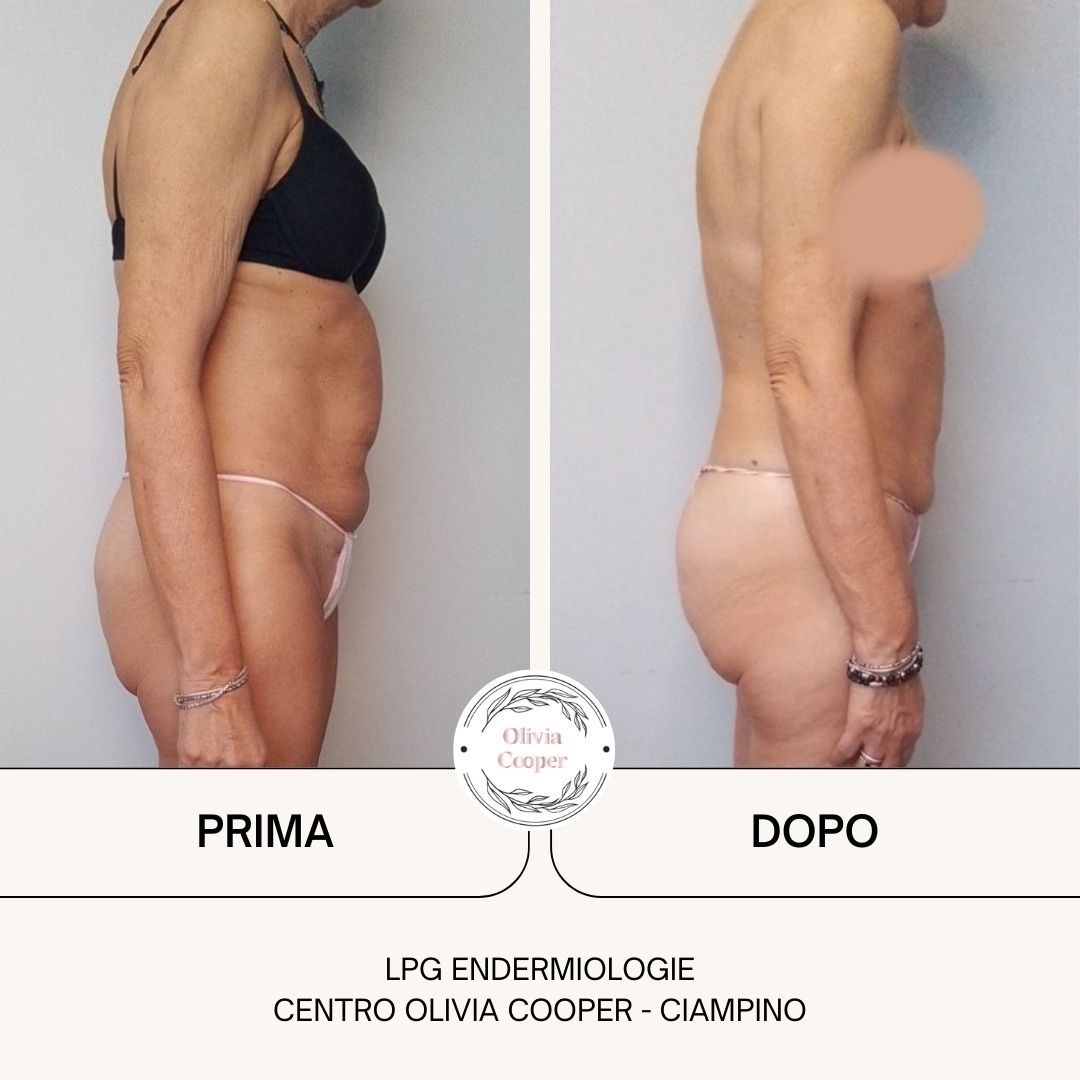 09-Prima-dopo-LPG
