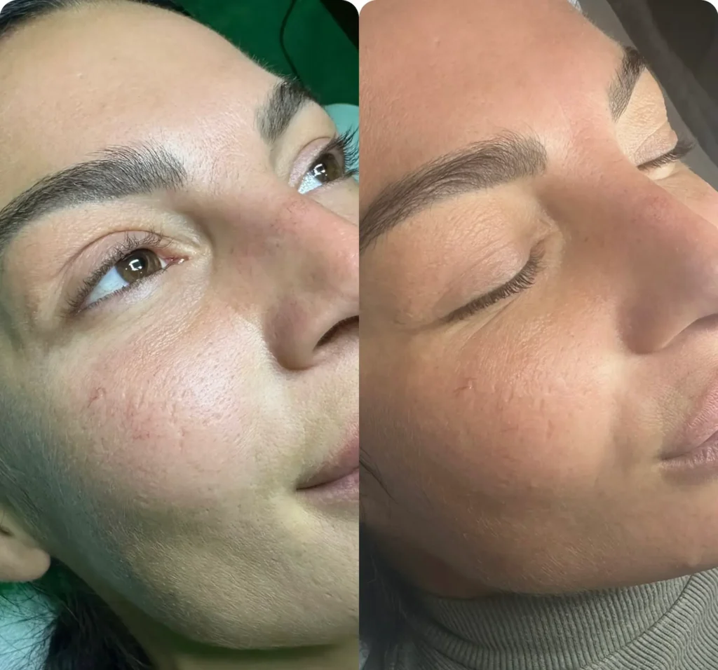 viso trattato con microneedling da Olivia Cooper