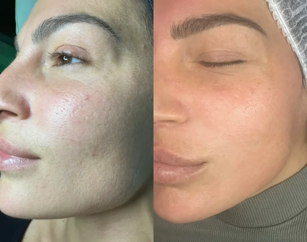 microneedling roma prima e dopo