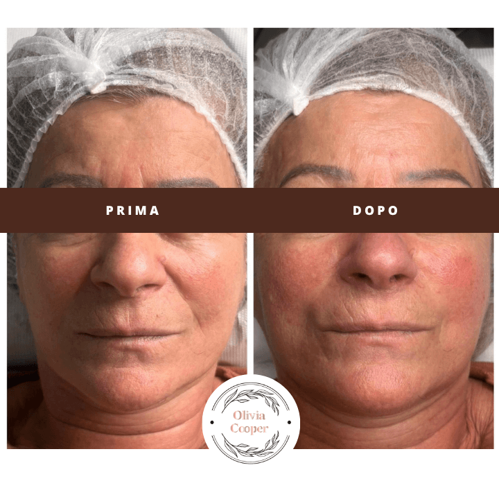 Massaggio viso liftante