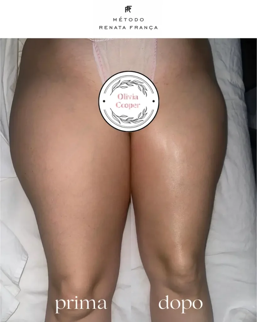 risultato del massaggio renata franca su gambe