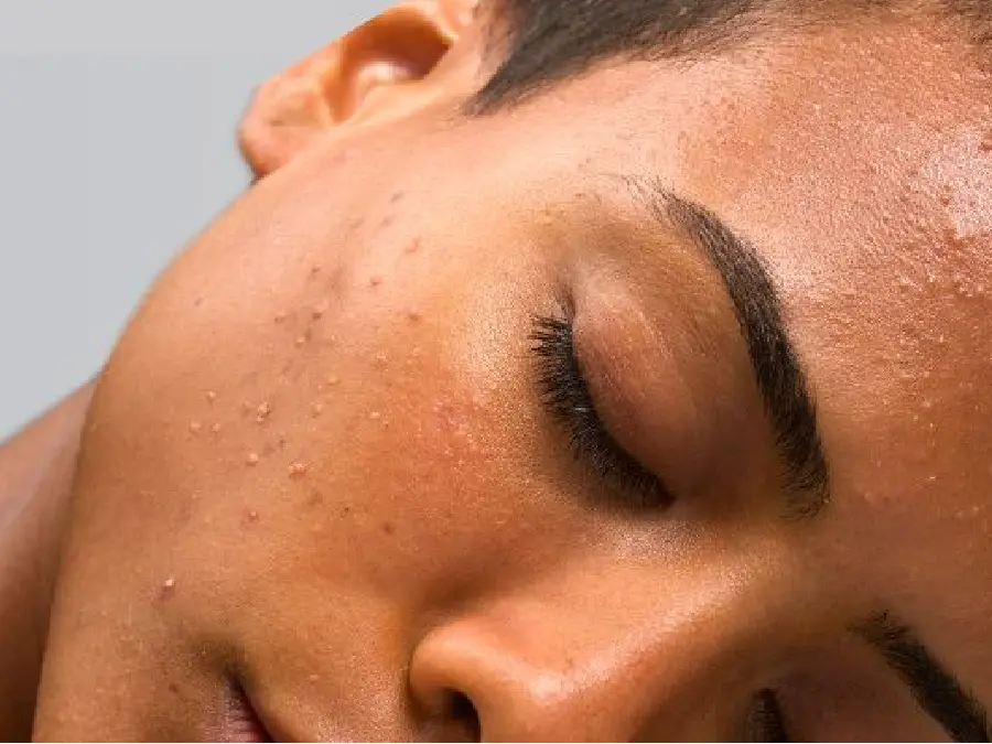 Viso con pelle grassa